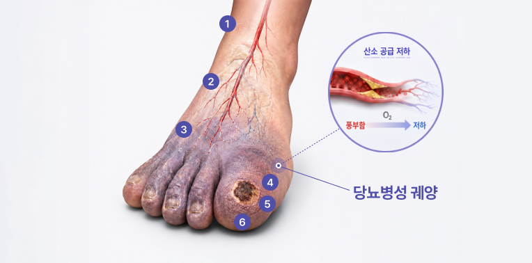 당뇨병성 궤양으로 발에 상처가 생긴 모습