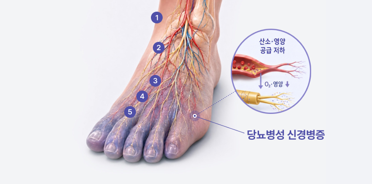 당뇨병성 신경통으로 발의 신경과 혈관에 산소와 영양 공급이 저하된 모습